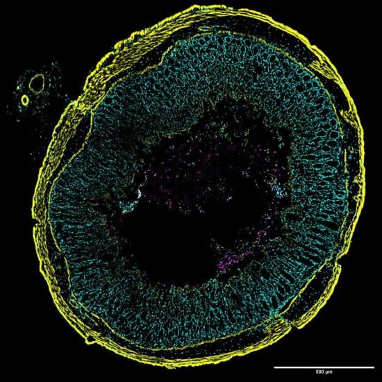 Clostridioides difficile