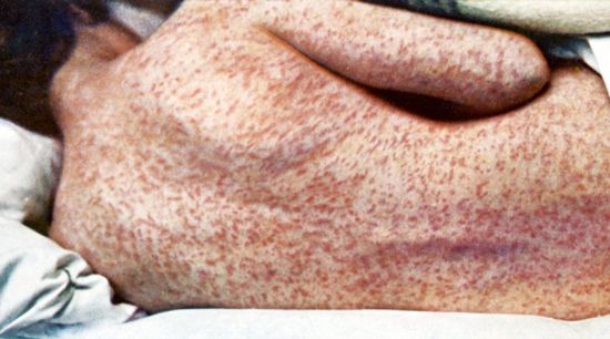 Back of female with measles. Wellcome / Wikimedia Commons
