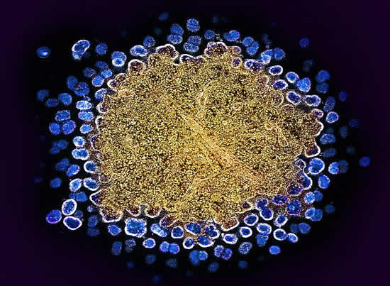 Colorized transmission electron micrograph of numerous HIV-1 virus particles (blue) replicating from a segment of a chronically infected H9 T cell (gold). NIAID