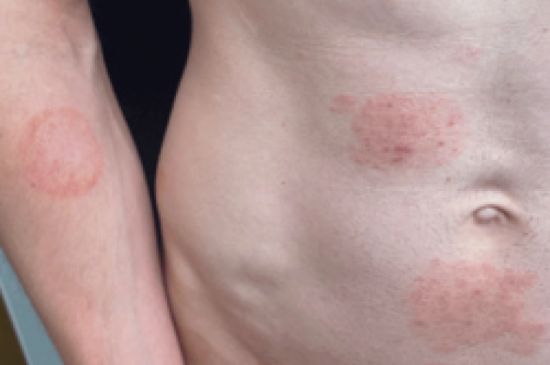 A ringworm skin rash caused by an infection of the fungus TMvii, which has emerged in some parts of the U.S. in the past year.