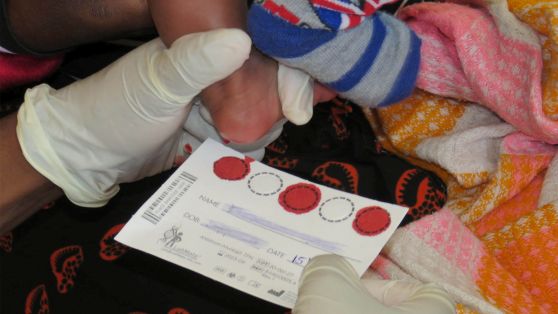 Dried blood spots being taken from a baby for HIV testing. HIV in Tanzania